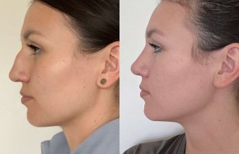 Female patient before and after rhinoplasty - left side