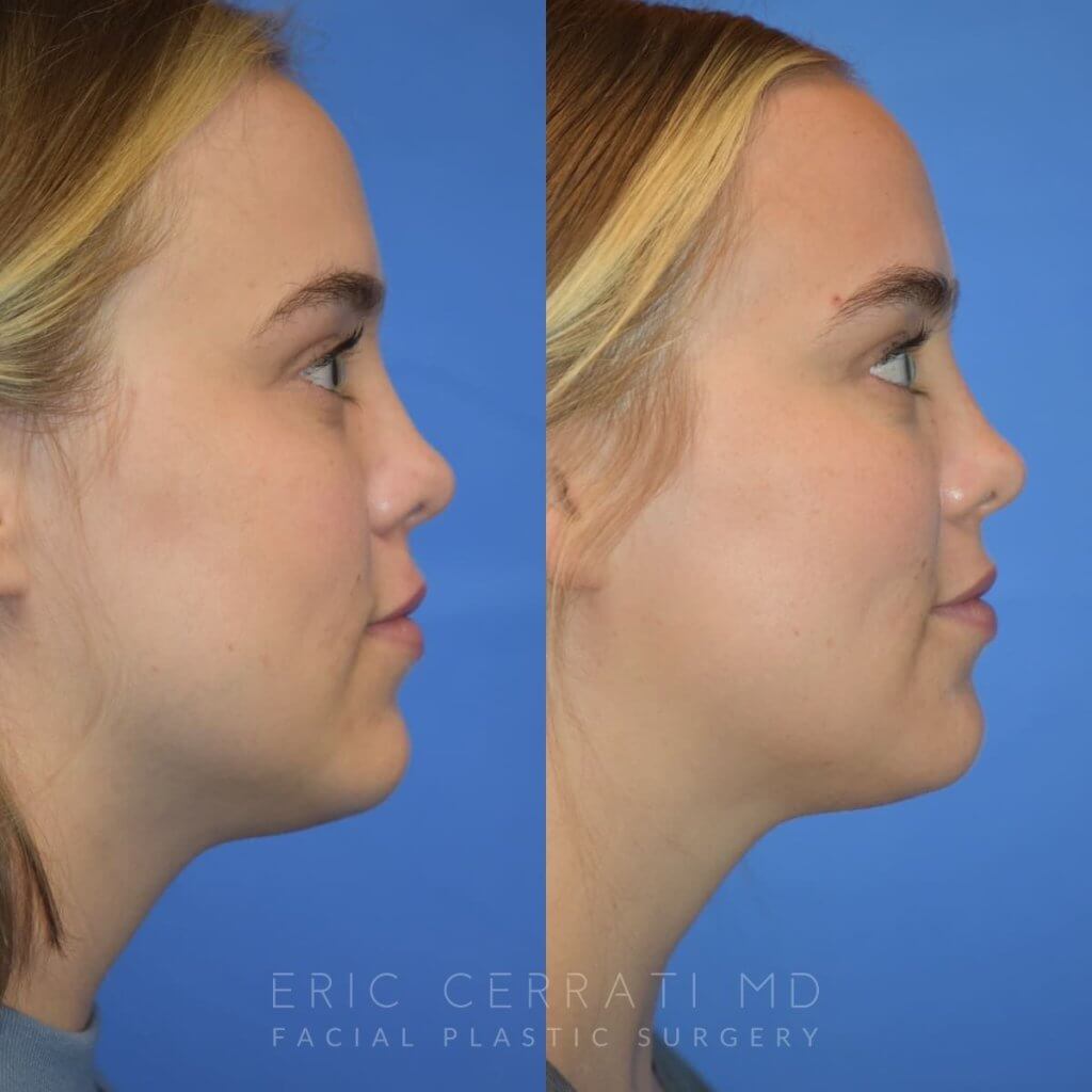 Photos of a woman's face before and after cheek reduction - right side