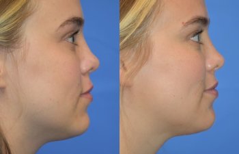 Photos of a woman's face before and after cheek reduction - right side