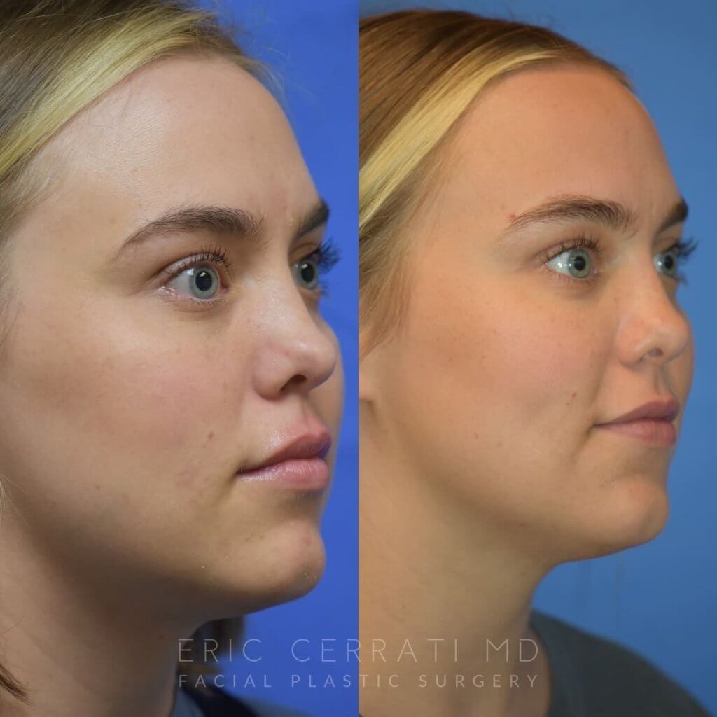 Photos of a woman's face before and after cheek reduction - right side