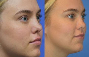 Photos of a woman's face before and after cheek reduction - right side
