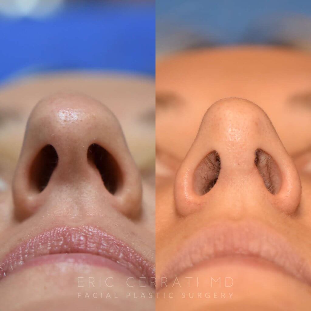 Female patient before and after rhinoplasty - front