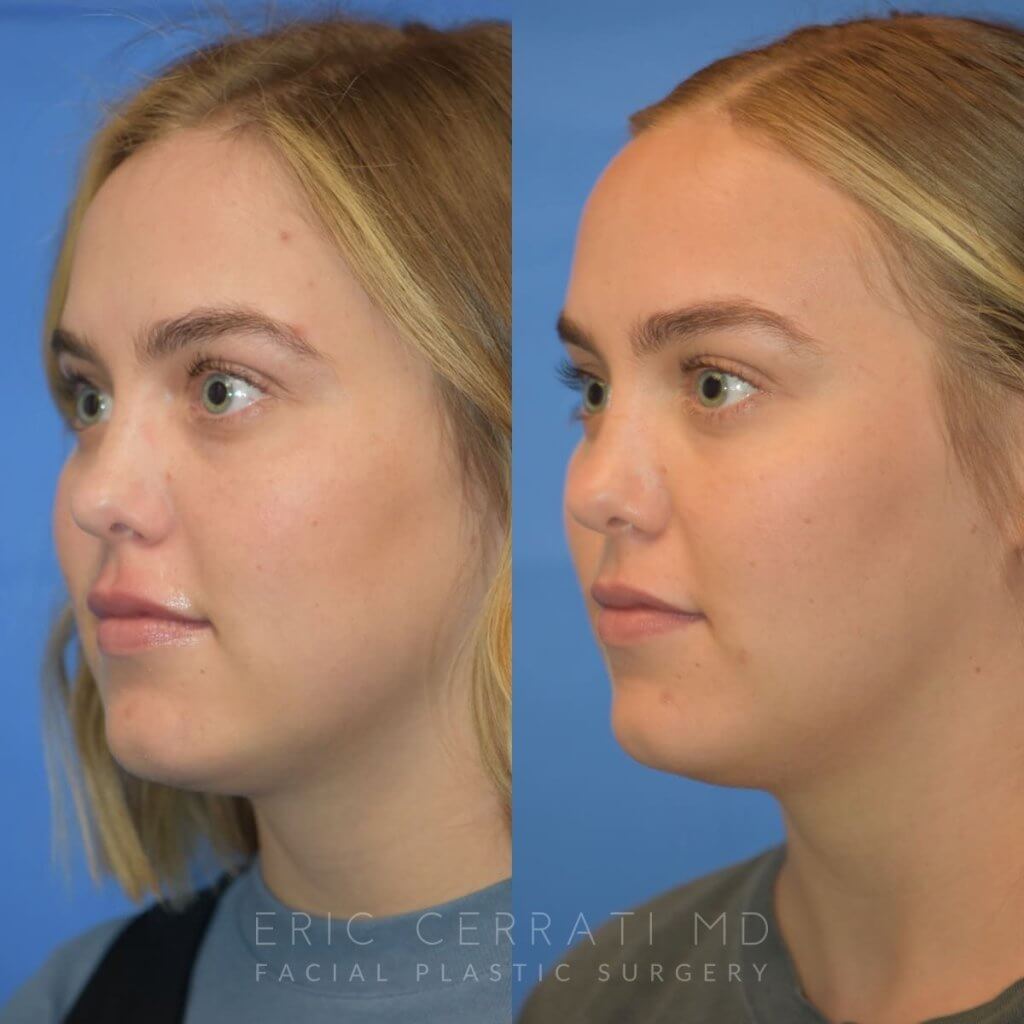Photos of a woman's face before and after cheek reduction - left side