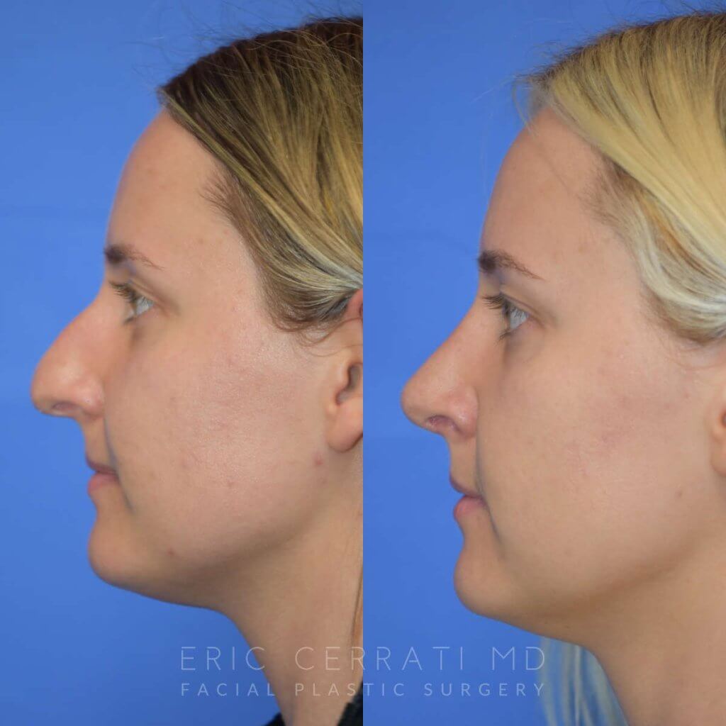 Female patient before and after rhinoplasty - left side