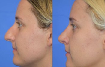 Female patient before and after rhinoplasty - left side