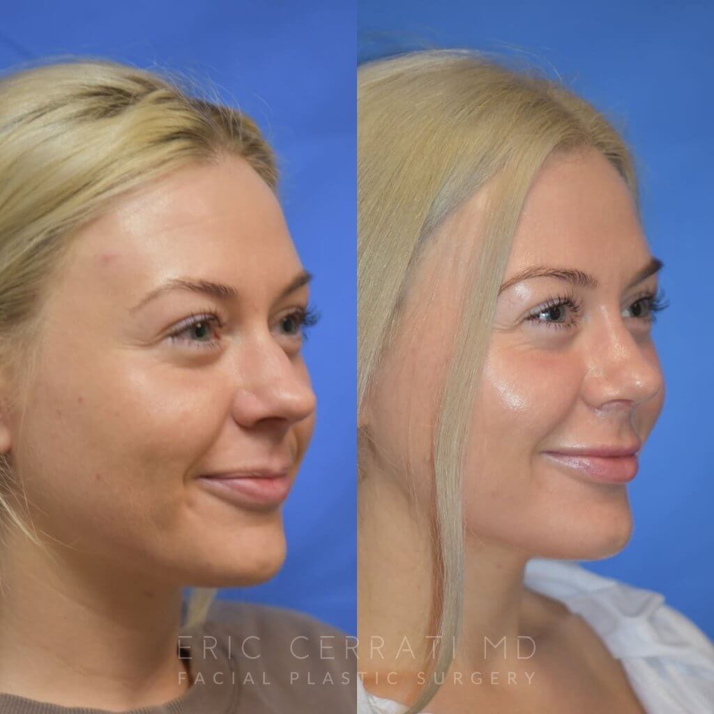 Female patient before and after rhinoplasty - right side