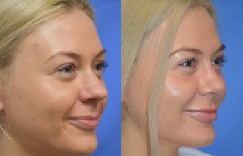 Female patient before and after rhinoplasty - right side