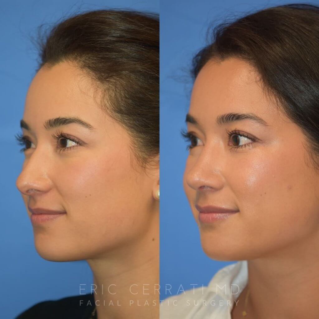 Female patient before and after rhinoplasty - right side