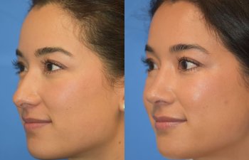 Female patient before and after rhinoplasty - right side