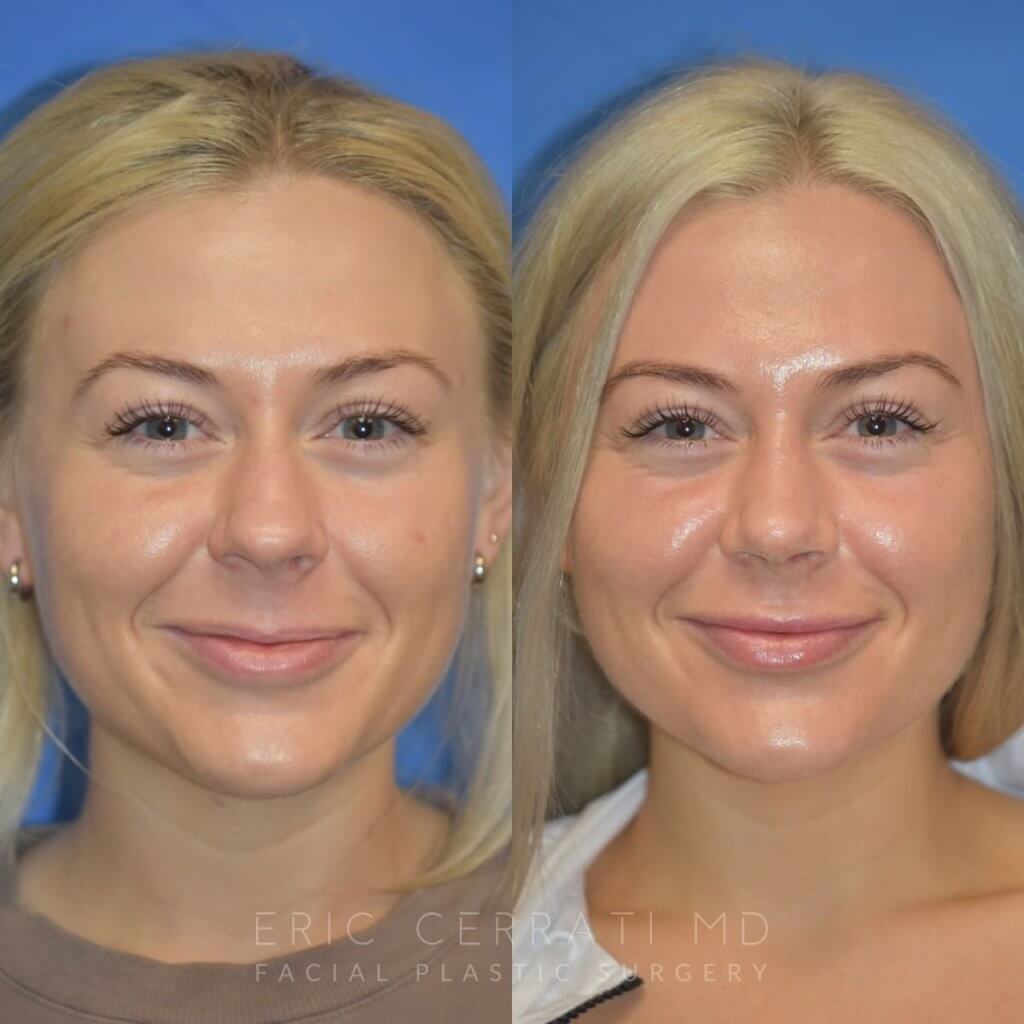 Female patient before and after rhinoplasty - front