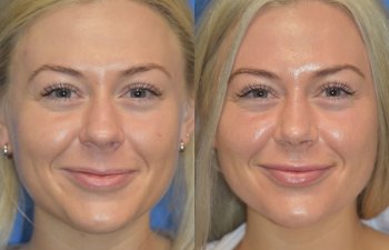 Female patient before and after rhinoplasty - front