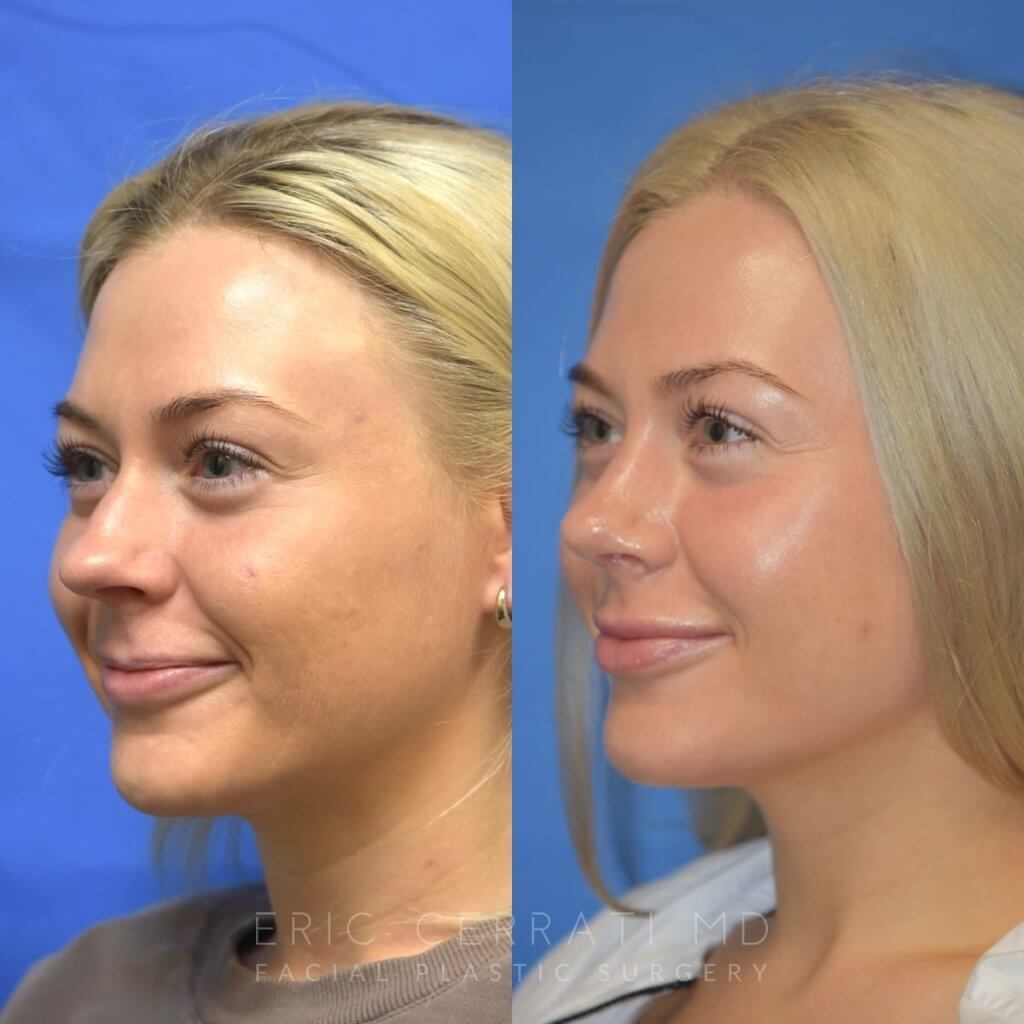 Female patient before and after rhinoplasty - left side