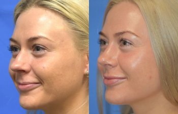 Female patient before and after rhinoplasty - left side