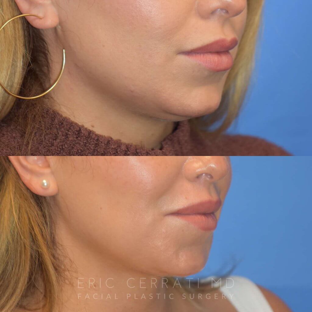 Photos of a woman's face before and after cheek reduction - right side