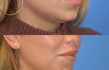 Photos of a woman's face before and after cheek reduction - right side