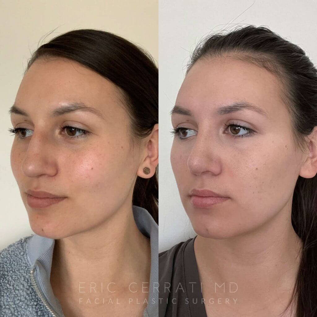 Female patient before and after rhinoplasty - left side