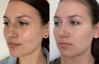 Female patient before and after rhinoplasty - left side