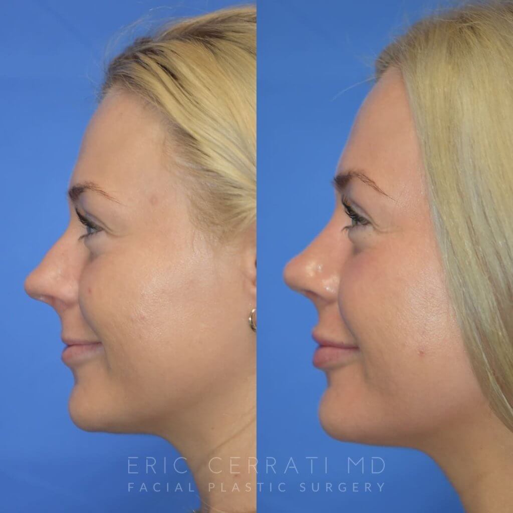 Female patient before and after rhinoplasty - left side