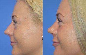 Female patient before and after rhinoplasty - left side