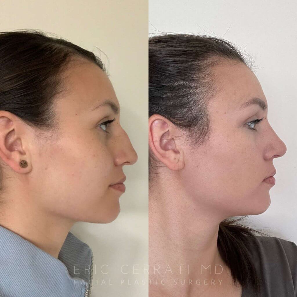 Female patient before and after rhinoplasty - right side