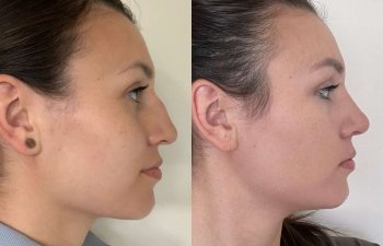 Female patient before and after rhinoplasty - right side