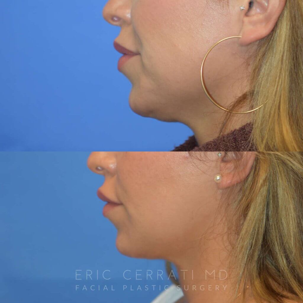Photos of a woman's face before and after cheek reduction - left side