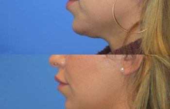 Photos of a woman's face before and after cheek reduction - left side