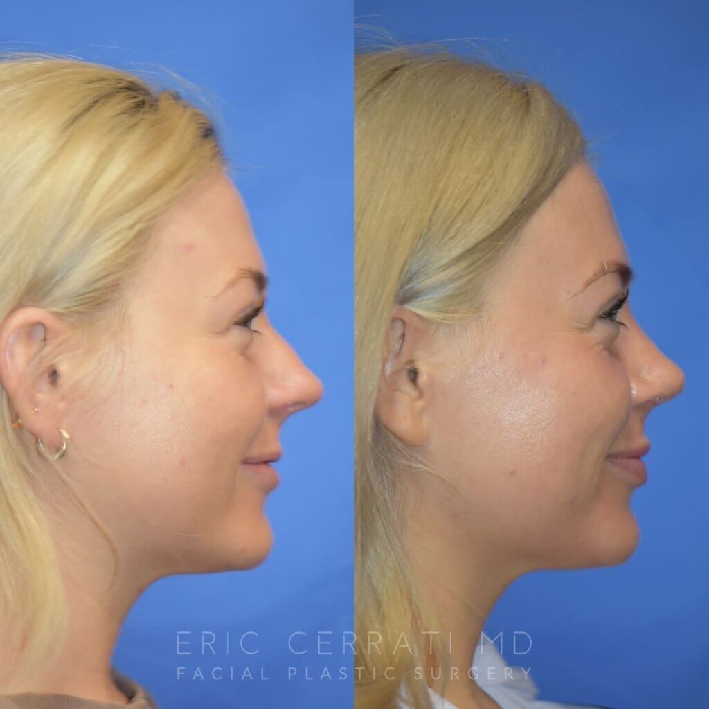 Female patient before and after rhinoplasty - right side