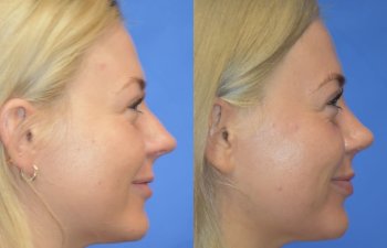 Female patient before and after rhinoplasty - right side