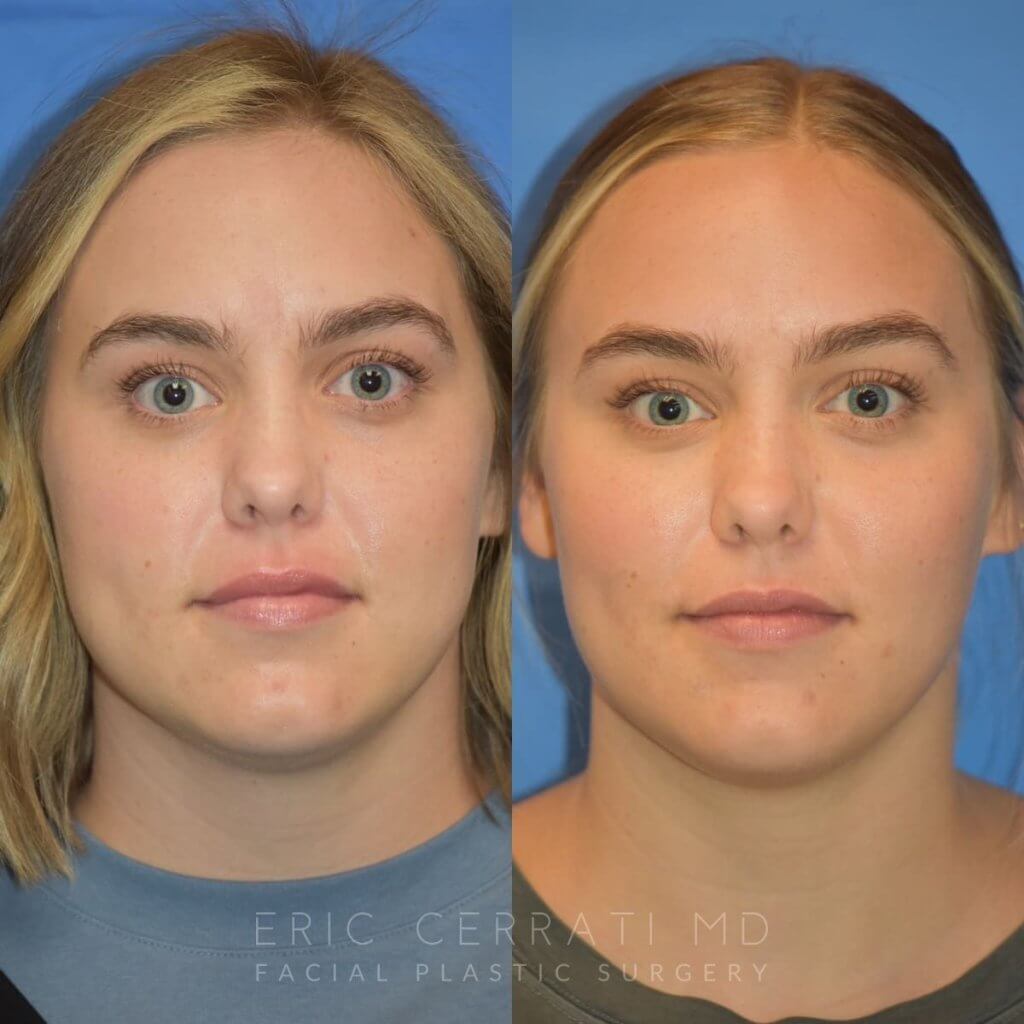 Photos of a woman's face before and after cheek reduction - front