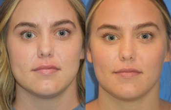 Photos of a woman's face before and after cheek reduction - front
