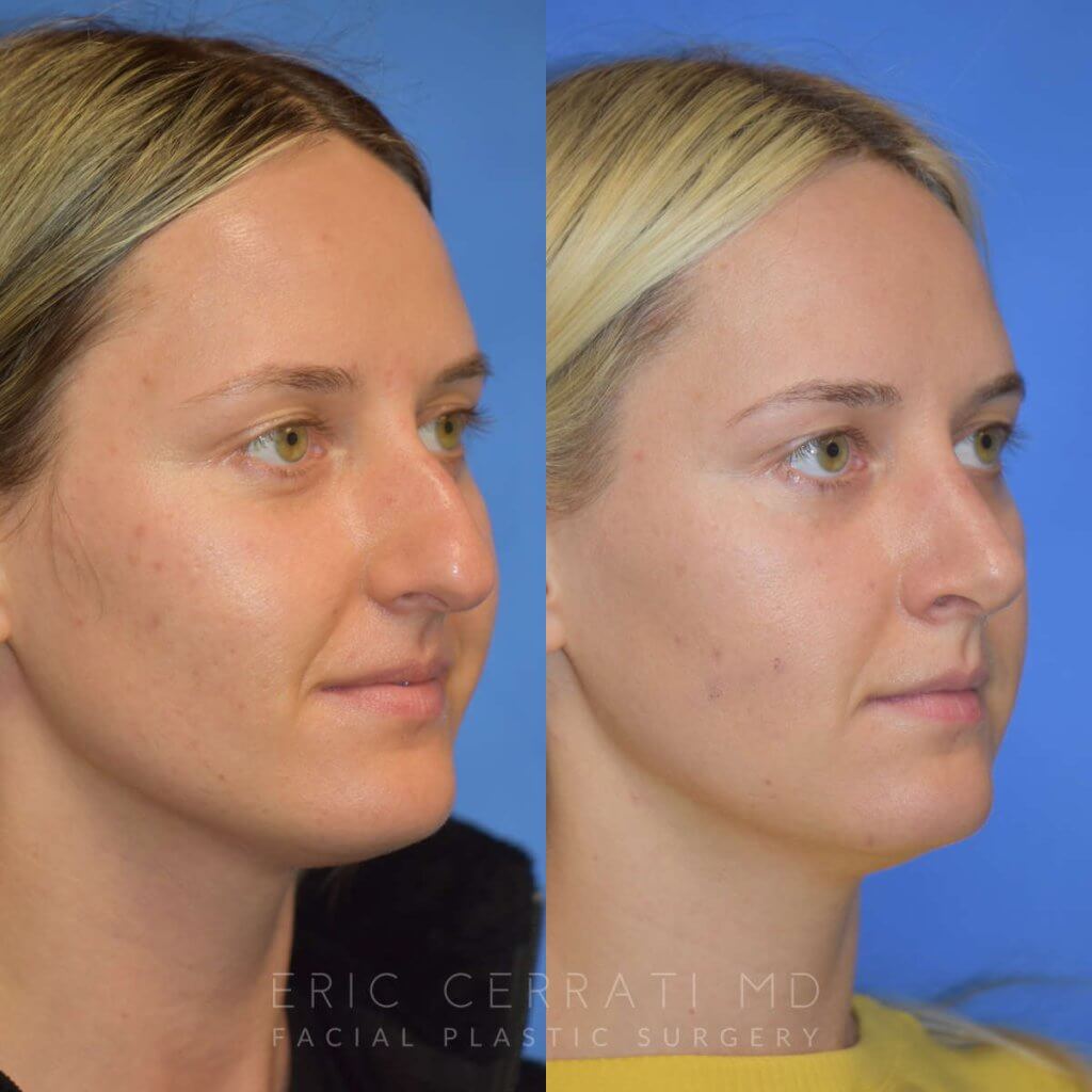 Female patient before and after rhinoplasty - right side