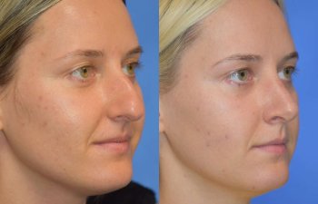 Female patient before and after rhinoplasty - right side
