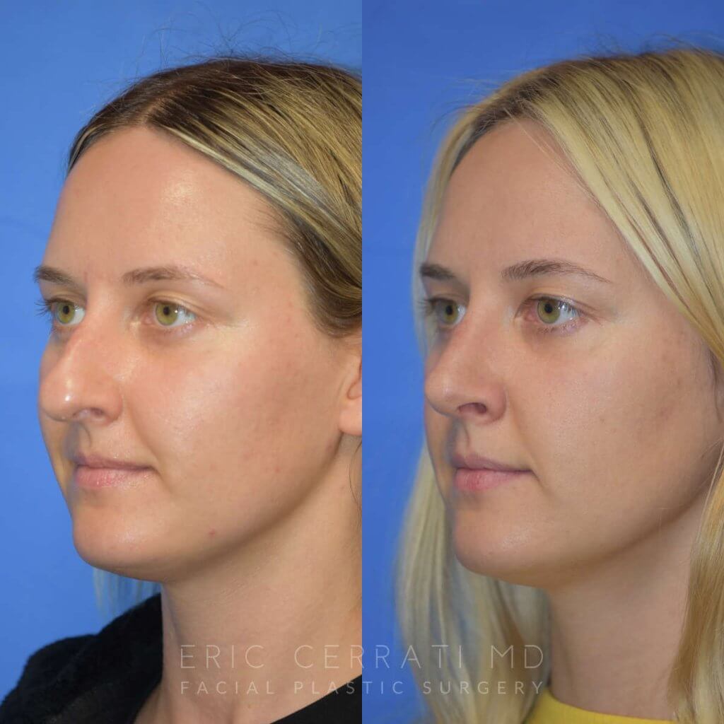 Female patient before and after rhinoplasty - left side