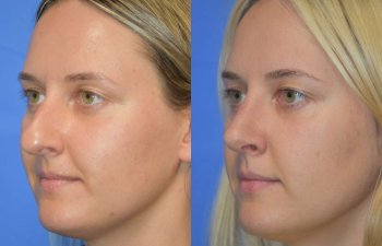Female patient before and after rhinoplasty - left side
