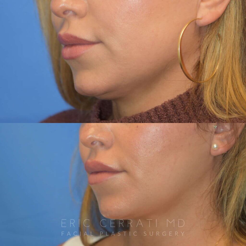 Photos of a woman's face before and after cheek reduction - left side