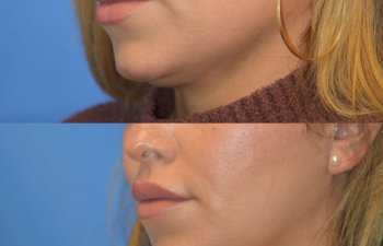 Photos of a woman's face before and after cheek reduction - left side