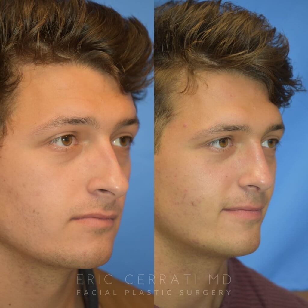 Male patient before and after rhinoplasty