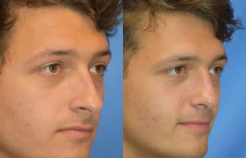 Male patient before and after rhinoplasty