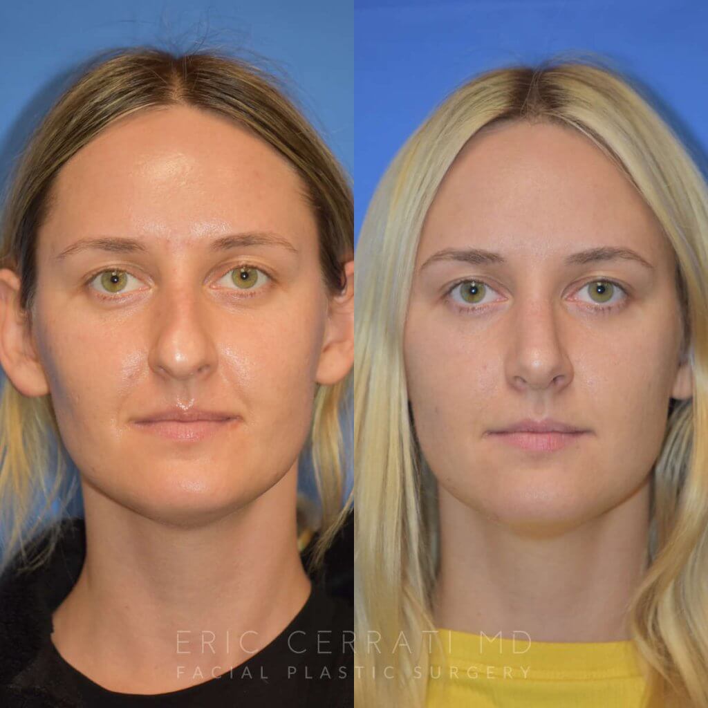 Female patient before and after rhinoplasty - front