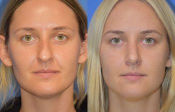 Female patient before and after rhinoplasty - front