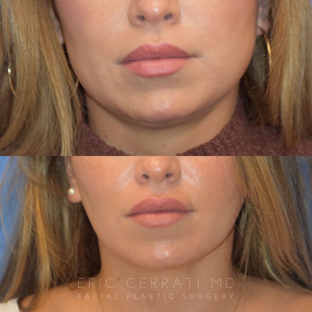 Photos of a woman's face before and after cheek reduction - from the front