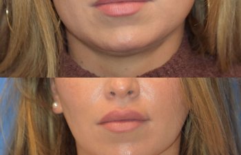 Photos of a woman's face before and after cheek reduction - from the front
