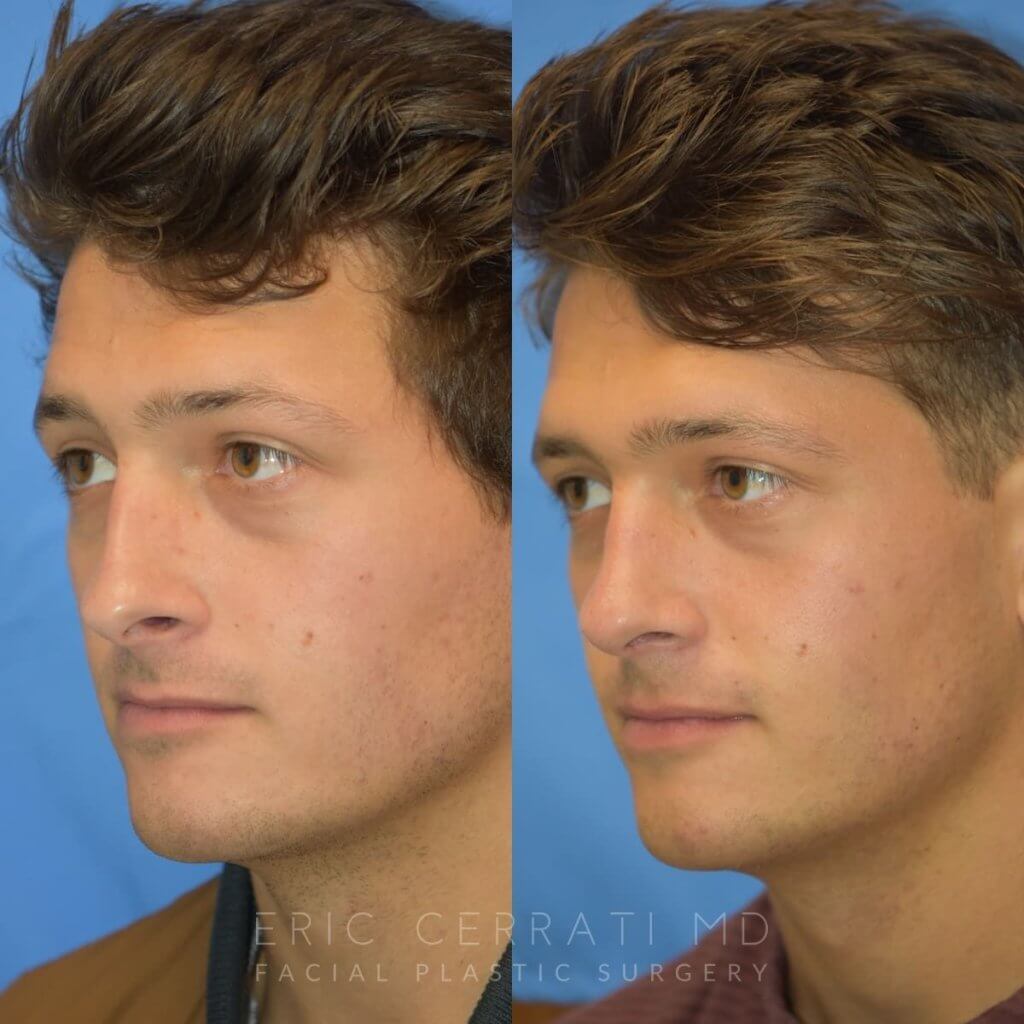 Male patient before and after rhinoplasty