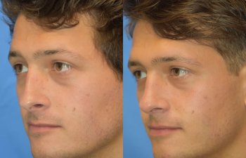 Male patient before and after rhinoplasty