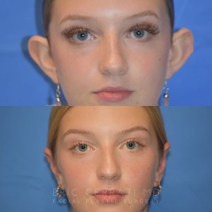 patient before and after ear surgery - front
