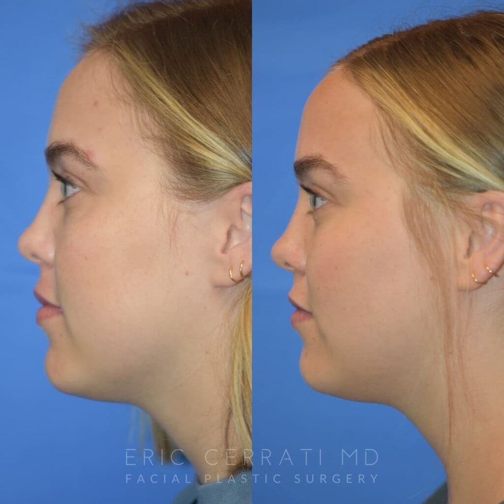Photos of a woman's face before and after cheek reduction - left side