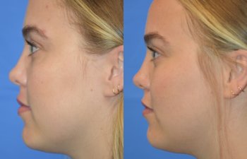 Photos of a woman's face before and after cheek reduction - left side