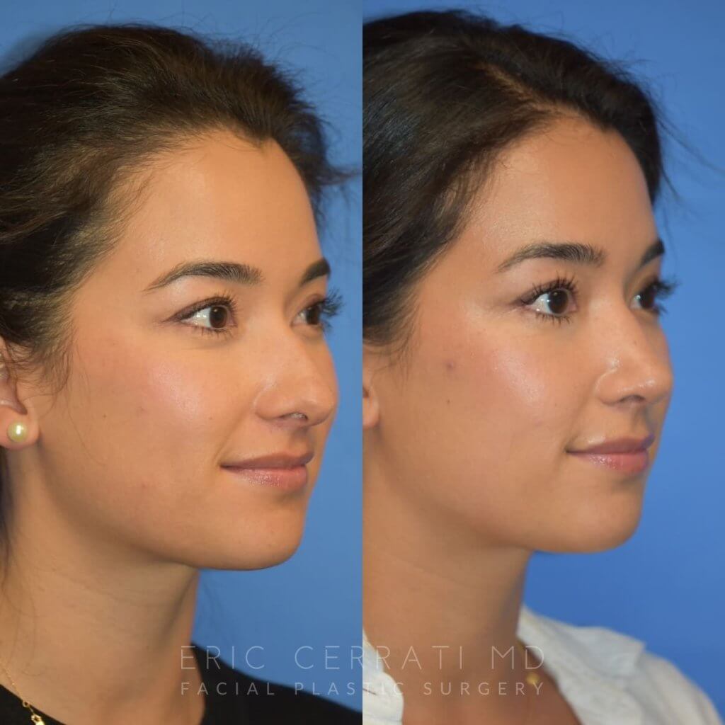 Female patient before and after rhinoplasty - right side