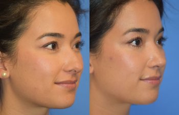 Female patient before and after rhinoplasty - right side